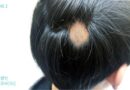 20~30대 탈모 증가, 스트레스·수면 부족이 주원인